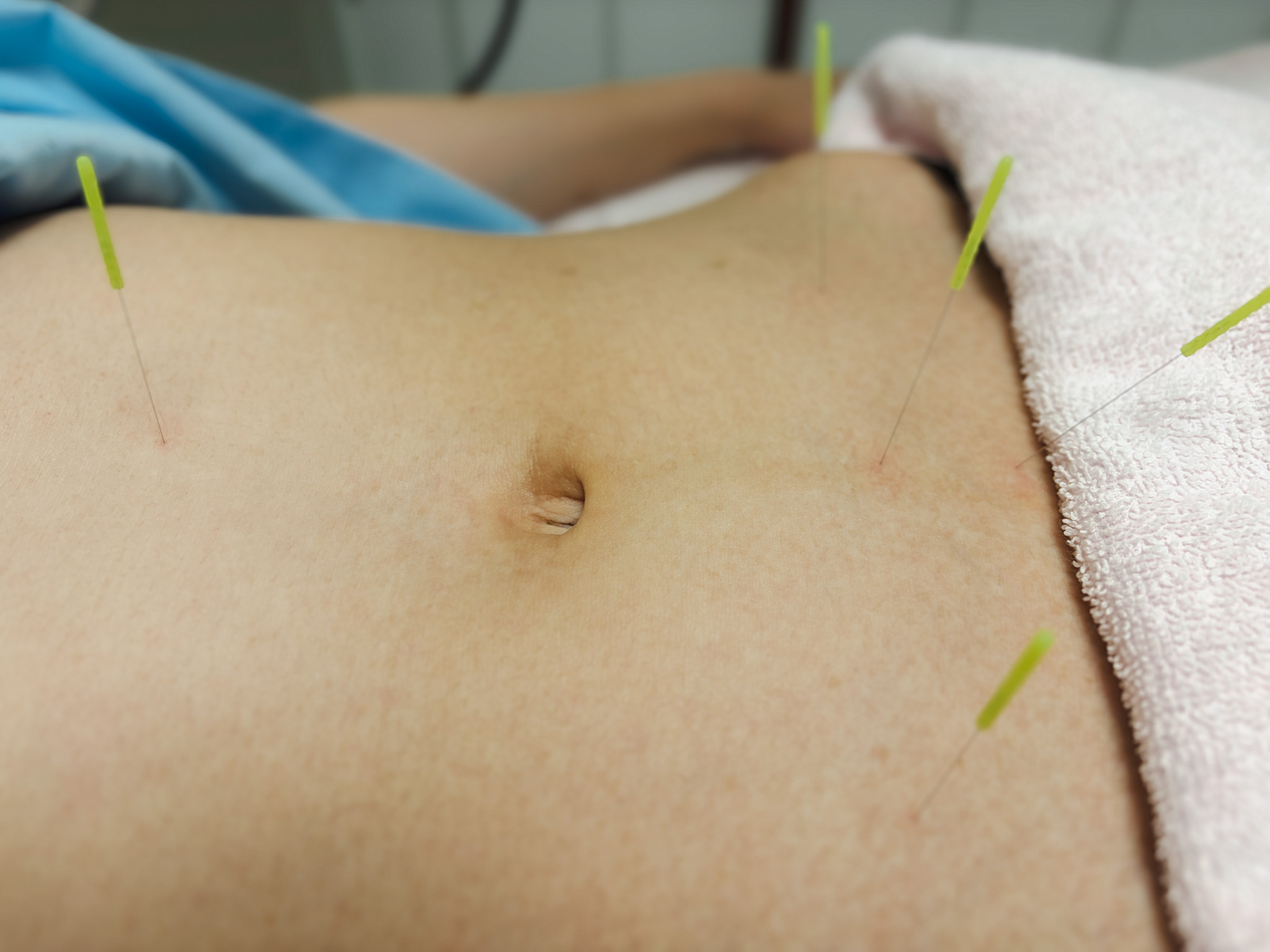 鍼灸不妊治療の施術